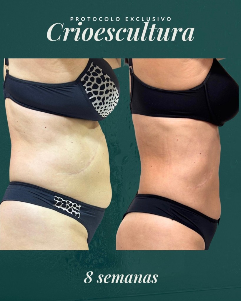 Antes e depois da CrioEscultura — resultado em 8 semanas
