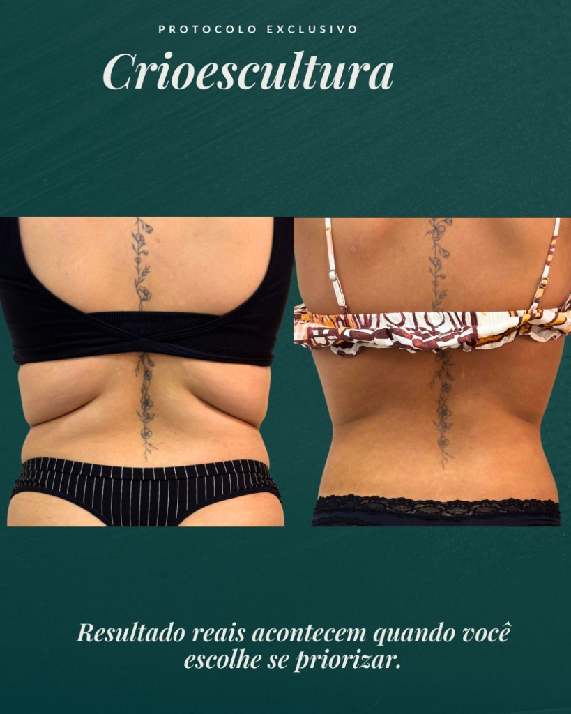 Antes e depois da CrioEscultura — contorno das costas
