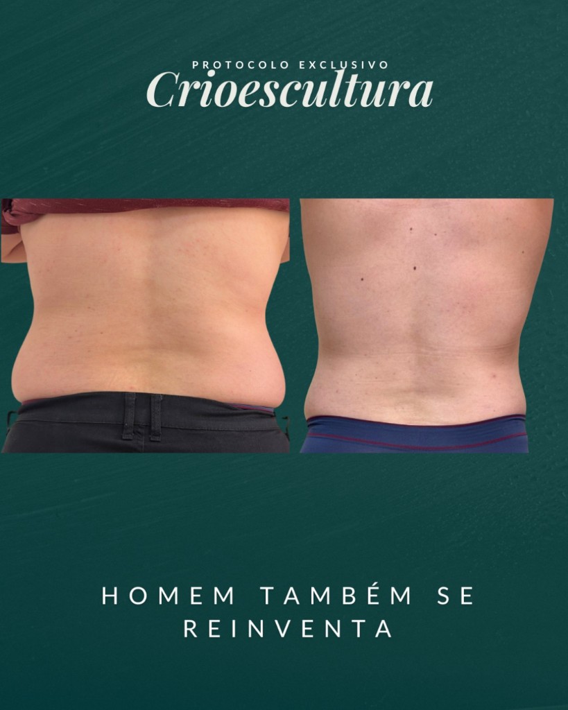 Antes e depois da CrioEscultura — resultado masculino
