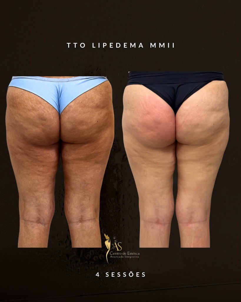 Antes e depois do tratamento de lipedema — resultado em 4 sessões