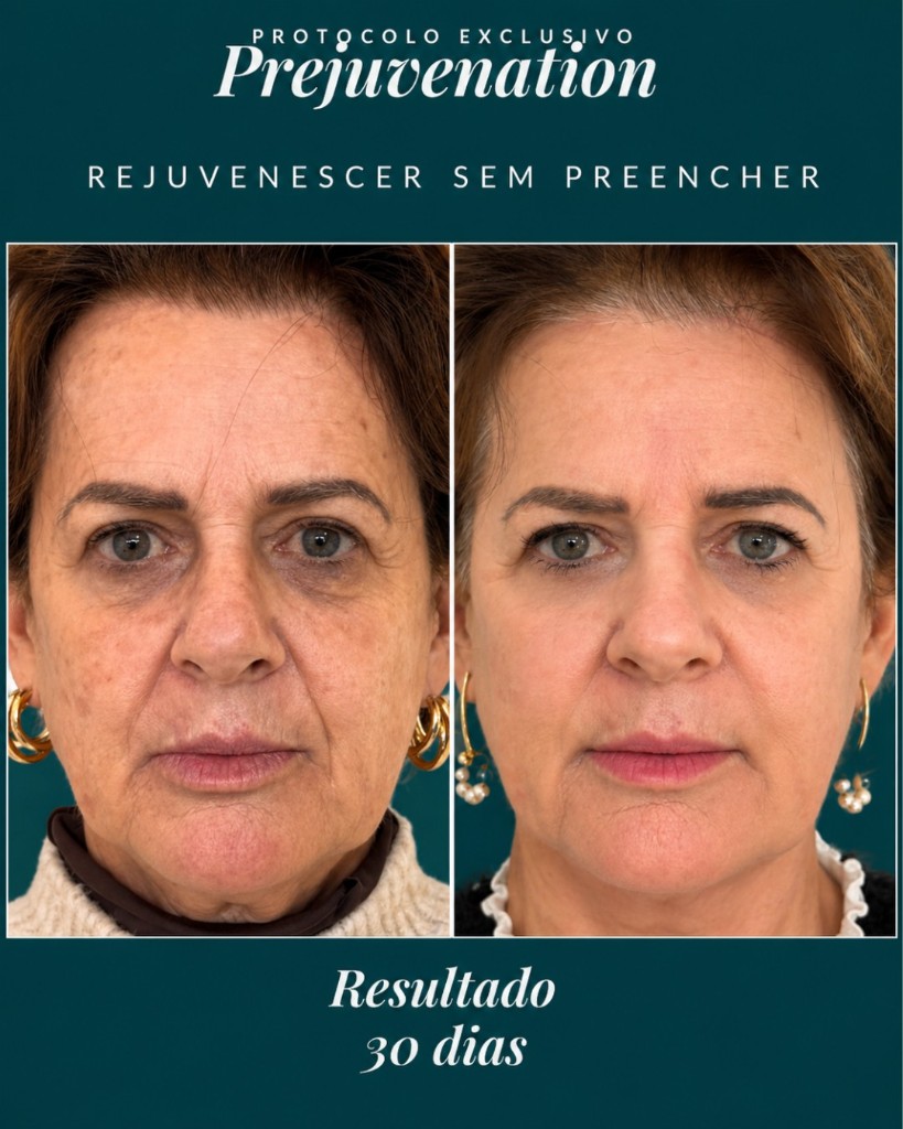 Antes e depois do protocolo Prejuvenation — resultado em 30 dias